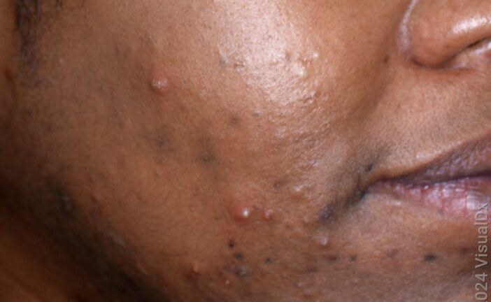 Here’s Why You Get Acne Around Your Period